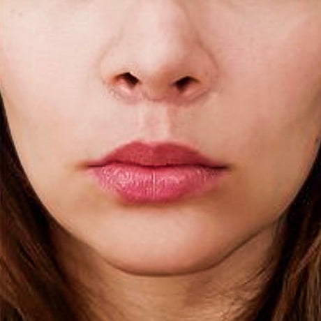 10-lip-fillers-fatigue-story-Po