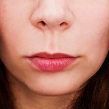 10-lip-fillers-fatigue-story